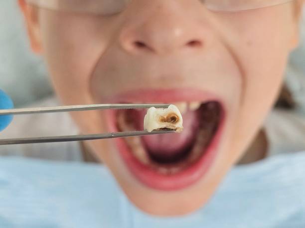 Best Emergency Dental Care for Broken or Chipped Teeth in Constantine, MI
